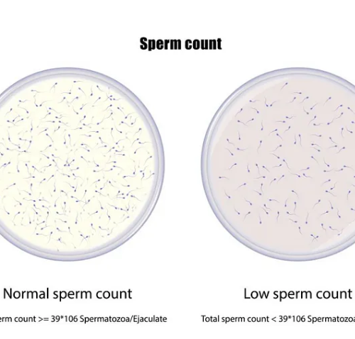 Low Sperm Count: Causes, Symptoms & Treatment
